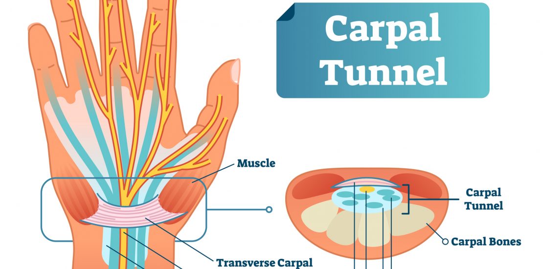 Sindrom de tunel carpian